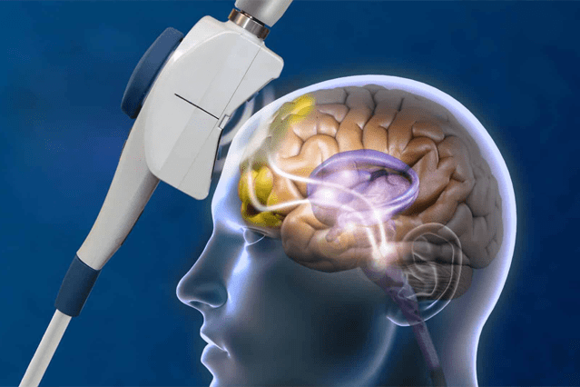 What Is the Difference Between TMS and rTMS?